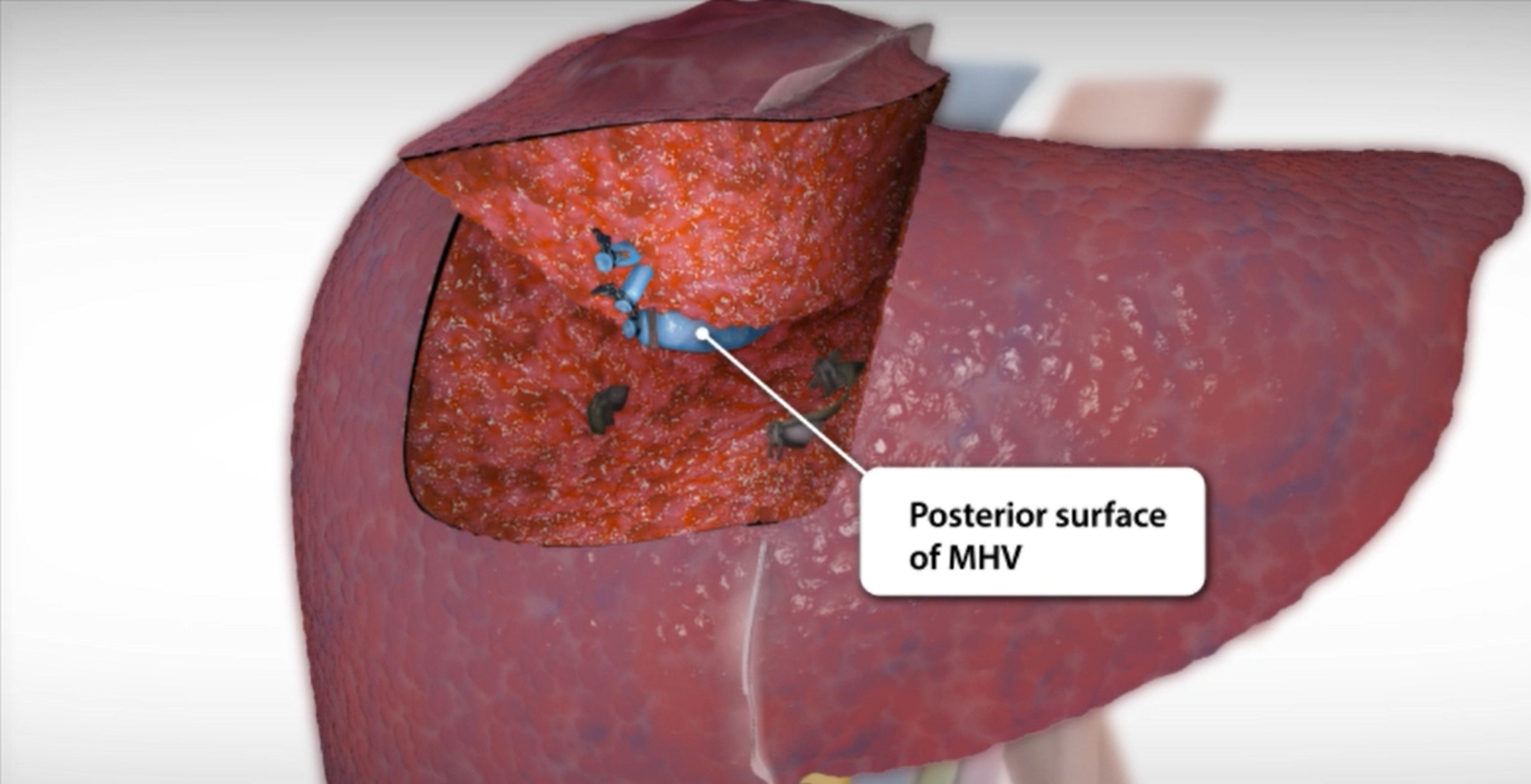 Clinical Liver Resection